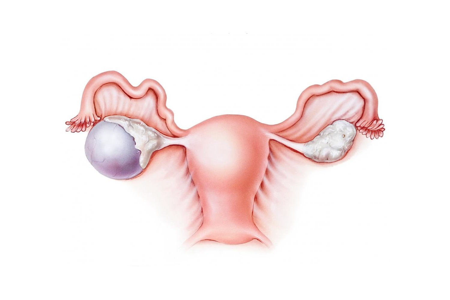 Лечение яичника у мужчин. Ретенционная киста яичника. Эндометриоидная киста яичника.