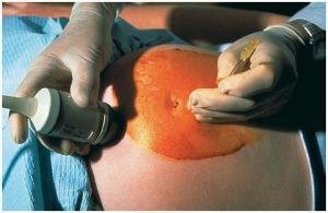 Amniocentesis Procedure